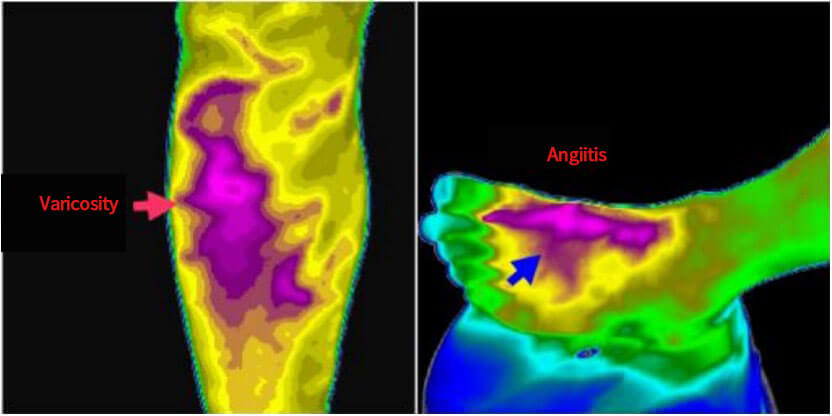 Infrared Thermal Imaging in Medical Diagnosis